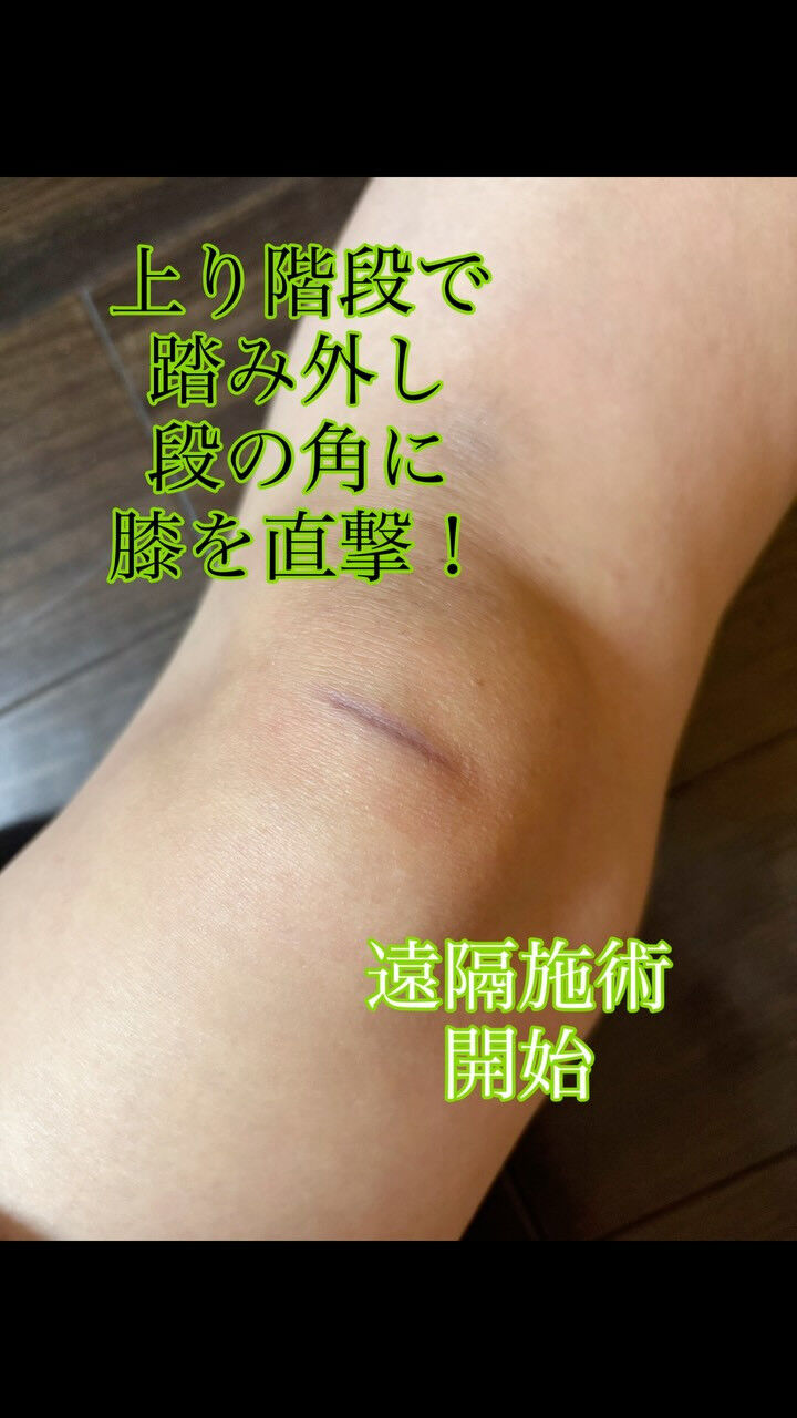 膝の打撲